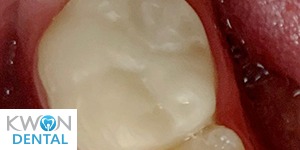 Close up of restored tooth after treatment from Dallas dentist