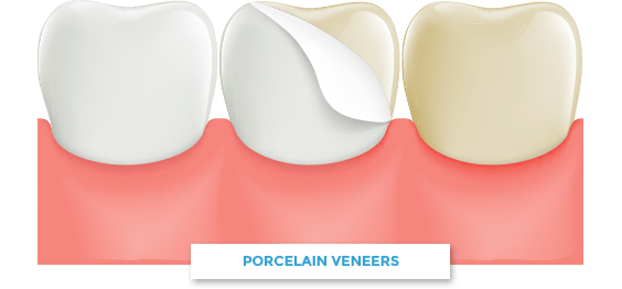 porcelain veneer cartoon on teeth
