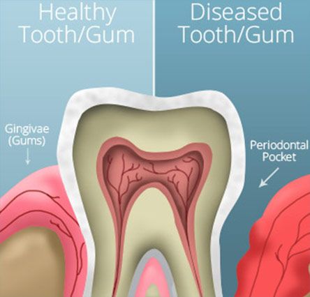 healthy versus diseased teeth