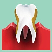 Tooth with decay cartoon