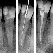 root canal x-ray