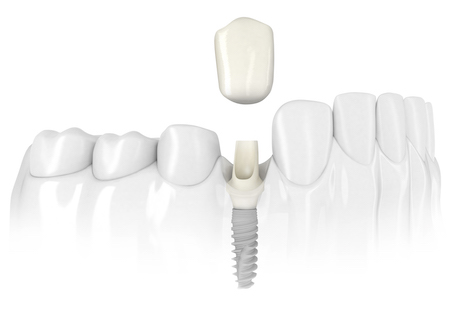 Animated dental crown being placed over dental implant in lower jaw