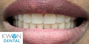 Close up of smile after replacing missing teeth at Kwon Dental