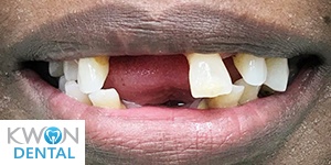 Close up of a smile with multiple missing teeth