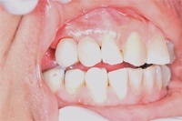 mouth after dental bridge