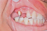 mouth before dental bridge