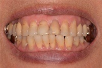 CEREC case