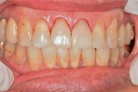 CEREC case