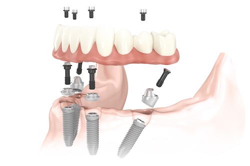 Animated All on 4 denture being placed onto four dental implants in lower arch