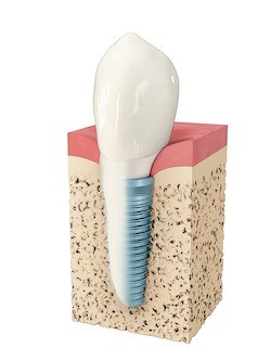 Animated dental implant with dental crown in the jaw