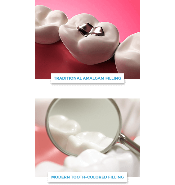 traditional versus tooth-colored fillings