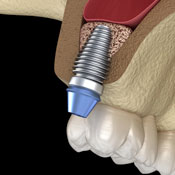 Picture of a sinus lift