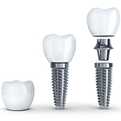 Animated dental implant crown and abutment
