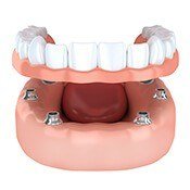 illustration of full dentures