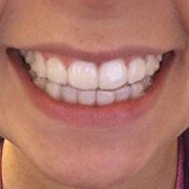 smile after invisalign
