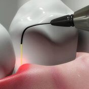 soft tissue laser illustration