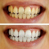 before and after teeth whitening