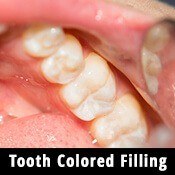 tooth colored fillings