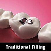 traditional metal fillings