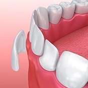 illustration of porcelain veneers closing gap