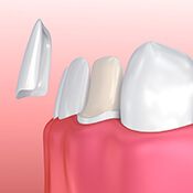 illustration of porcelain veneers