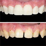 veneers before and after