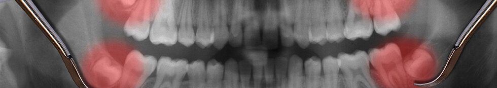 wisdom tooth x-rays