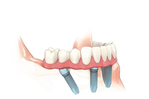 Animated All on 4 implant denture on lower arch