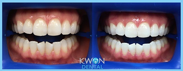 Close up of teeth before and after teeth whitening in Dallas