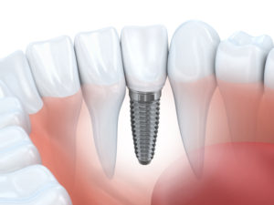 Your dentist in Dallas provides dental implants. 