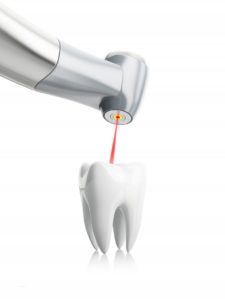 A dental laser pointing at a tooth.