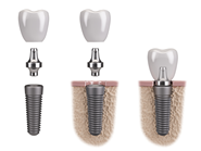 Parts of dental implants