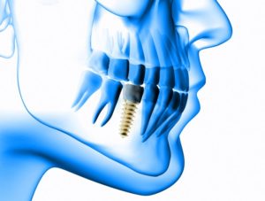 x-ray view of dental implant