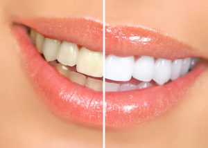woman smiling before and after