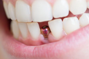 implant in mouth